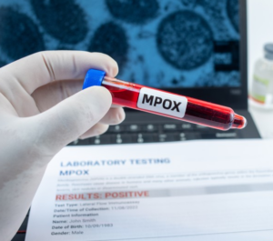 Confirmed Mpox cases in SA rise to 22